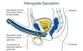 eiaculazioneretrograda-centromedico001